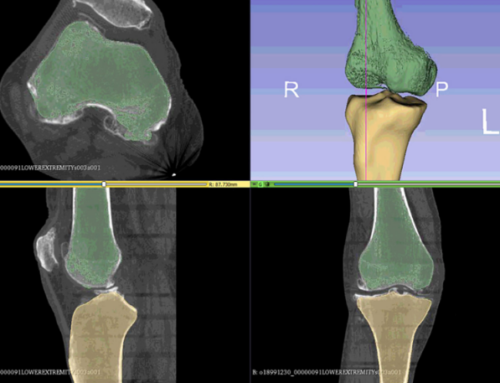 Total Knee Replacement: Subject-Specific Modeling, Finite Element Analysis and Evaluation of Dynamic Activities  —  Frontiers in Bioengineering and Biotechnology,  2021